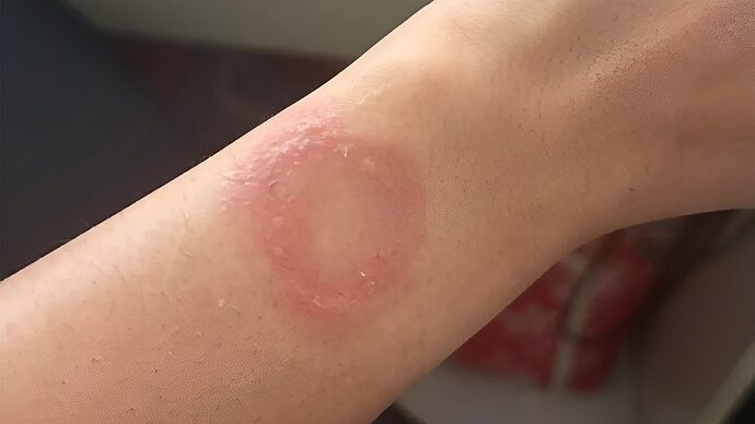 ผู้ใช้ Apple Watch เผยข้อมือไหม้จากความร้อนสูง ร้องเรียน Apple กว่า 6 เดือนแต่ยังไร้การแก้ไข